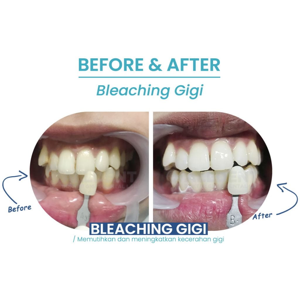 Promo Bleaching Gigi 2