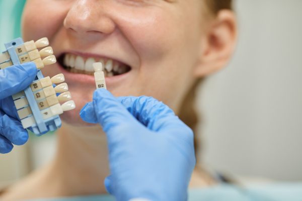 Kelebihan dan Kekurangan Menggunakan Veneer Gigi