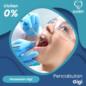 Pencabutan Gigi