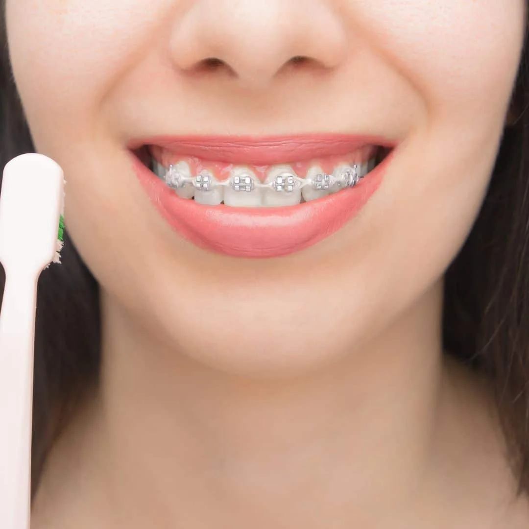 Faedah Self-Ligating Braces untuk Rawatan Pergigian yang Lebih Cepat dan Selesa